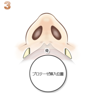 鼻翼基部プロテーゼ術：挿入後イメージ