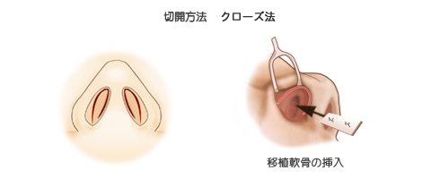 鼻中隔延長術:切開法クローズ法