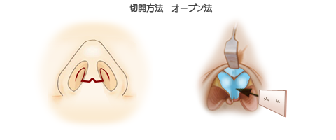 鼻中隔延長術:切開法オープン法