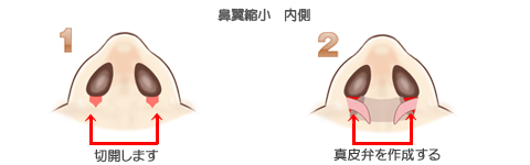 鼻翼縮小術内側、切除と真皮弁の作成