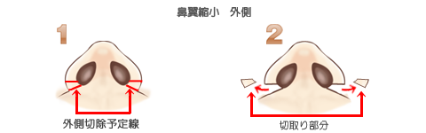 鼻翼縮小術外側
