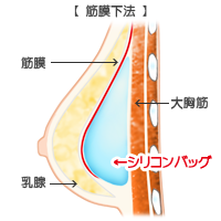 筋膜下法