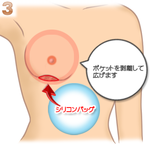 被膜(カプセル)拘縮、剥離範囲を広げる