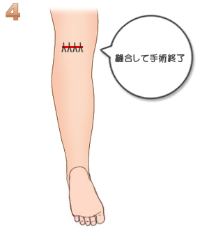 下腿部筋萎縮術（ＴＣＲ）：縫合