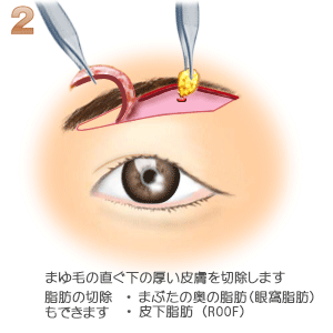 上眼瞼リフト、皮膚の切除