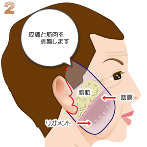 頬部フェイスリフト：皮膚と筋肉の剥離
