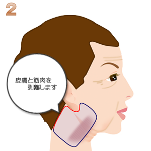 頸部フェイスリフト：皮膚と筋肉の剥離