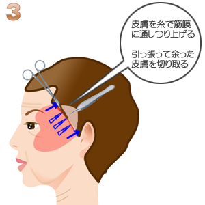 こめかみリフト術：額の皮膚のつり上げ