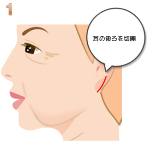 リボンリフト:切開部分
