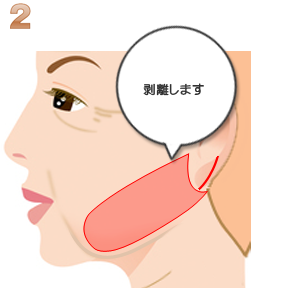 リボンリフト:剥離