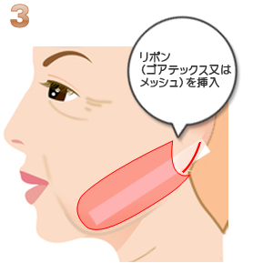 リボンリフト:リボンの挿入