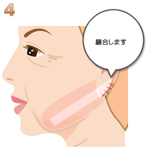 リボンリフト:縫合