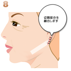 リボンリフト:切開部分の縫合