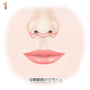 上口唇短縮術、切除範囲のデザイン