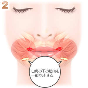 口唇拡大手術 口角の筋肉を一部カット