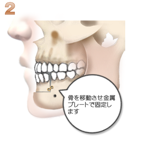 下顎前突：骨の移動