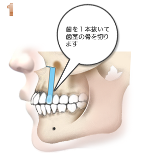 上顎前突：１本抜歯と骨きり