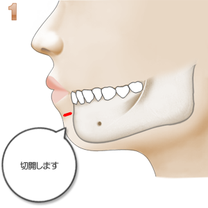 アゴプロテーゼ、切開部分