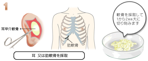 隆鼻術：自家組織軟骨採取