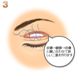 重瞼修正術（二重幅を広げる／切開法）：皮膚と腱膜の縫合