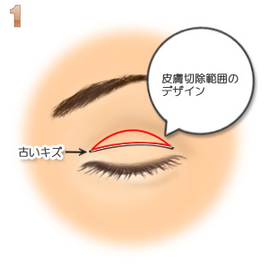 重瞼修正術（二重幅を広げる／切開法）：二重デザイン