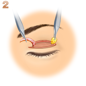 重瞼修正術（二重幅を広げる／切開法）：切開
