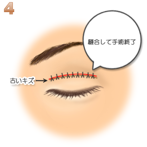 重瞼修正術（二重幅を広げる／切開法）：縫合して終了