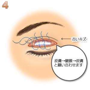 重瞼修正術（二重幅を狭める）：切開
