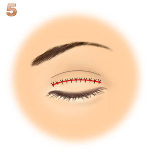 重瞼修正術（二重幅を狭める）：皮膚と瞼膜の縫合